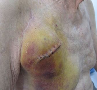 Expanded hematoma following pacemaker insertion